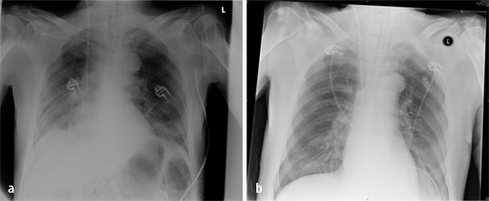 Pneumonie Vap Ventilatorassoziierte Pneumonie | Die Innere Medizin