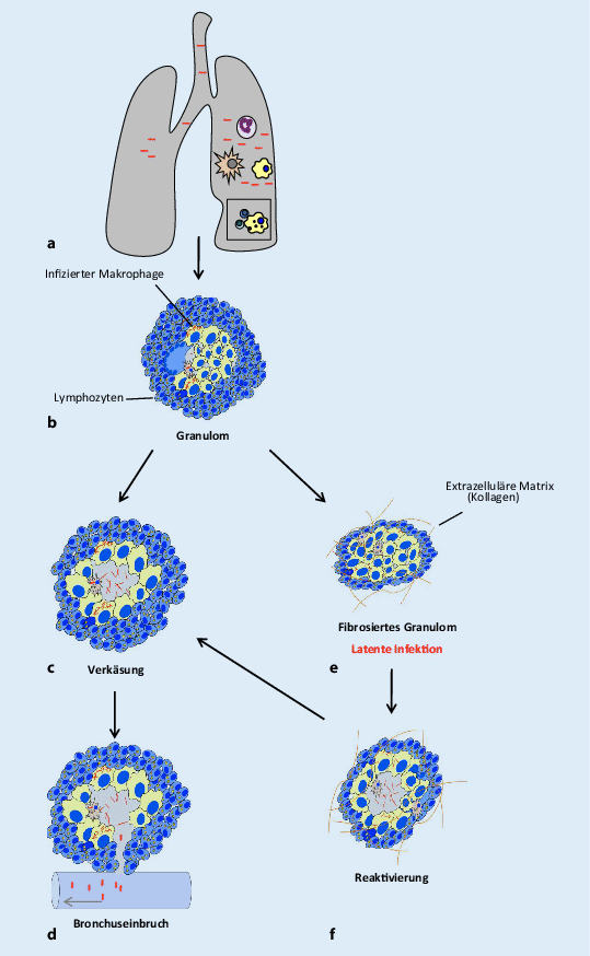 Immunitat Gegen Mycobacterium Tuberculosis Springerlink