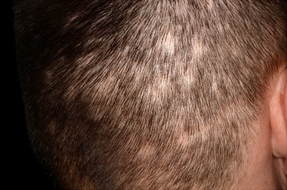 Arzneimitteltherapie der Alopezien | SpringerLink