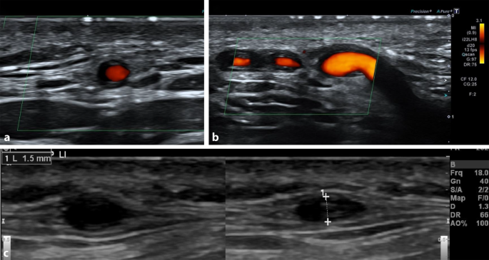 Grossgefassvaskulitiden Riesenzellarteriitis Und Takayasu Arteriitis Springerlink