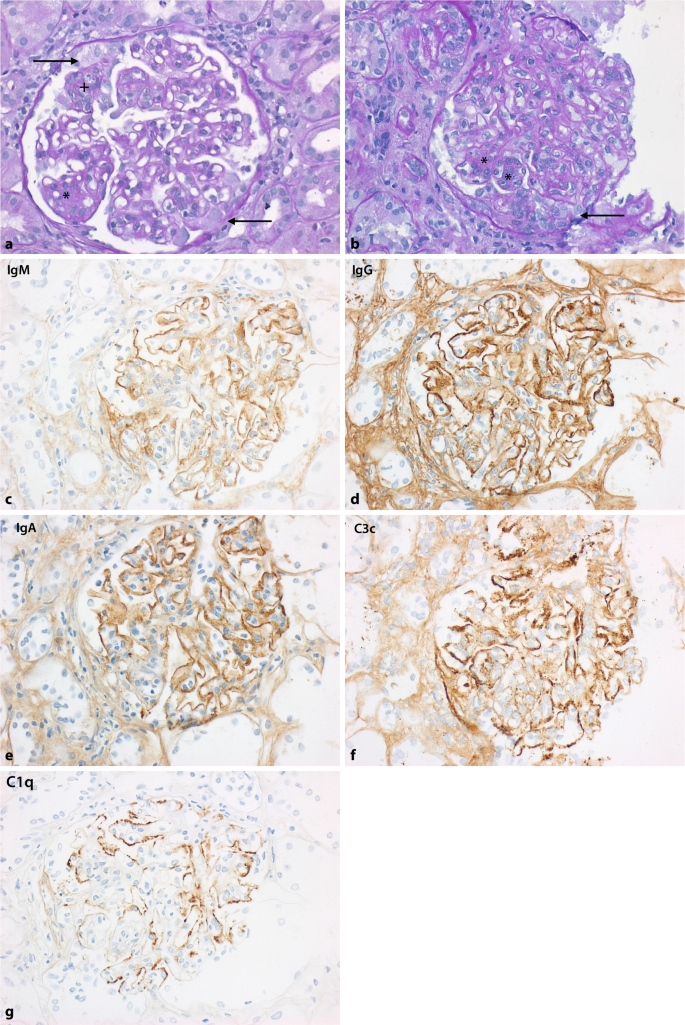 Lupusnephritis Springerlink