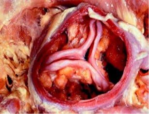 Aortic stenosis is largely a boney affair | Journal of Molecular Medicine