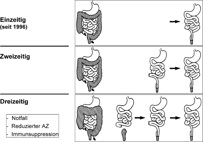 Chirurgische Therapie der Colitis ulcerosa im Kindesalter | Monatsschrift  Kinderheilkunde | Springer Nature Link