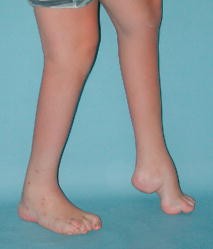 Kindliche Fußfehlformen | SpringerLink