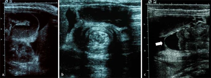 Ileokolische Invagination Beim Jungen Saugling Springerlink