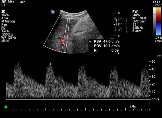 Farbkodierte Duplexsonographie Vor Und Nach Lebertransplantation Bei Kindern Springerlink