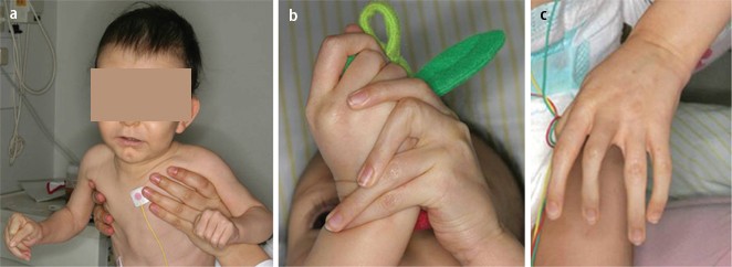 Neugeborenes Mit Arachnodaktylie Arthrogryposis Und Aortendilatation Springerlink