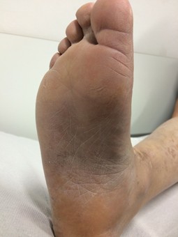 Lepra Und Buruli Ulkus Springerlink