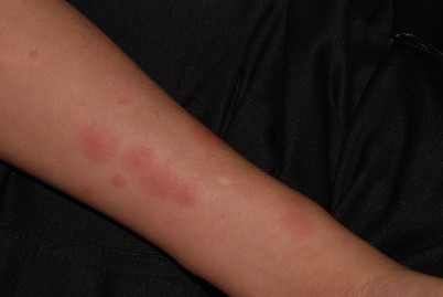 Lepra Und Buruli Ulkus Springerlink