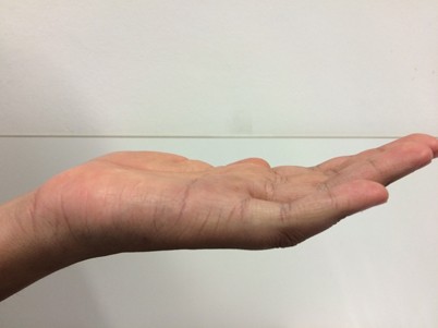 Lepra Und Buruli Ulkus Springerlink