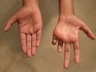 Lepra Und Buruli Ulkus Springerlink