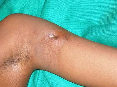 Lepra Und Buruli Ulkus Springerlink