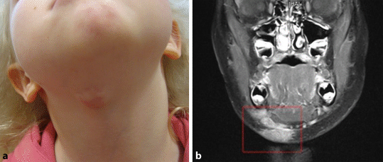Submandibulare Lymphknotenschwellung Bei Einem 3 Jahrigen Madchen Springerlink