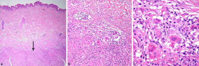 Submandibulare Lymphknotenschwellung Bei Einem 3 Jahrigen Madchen Springerlink