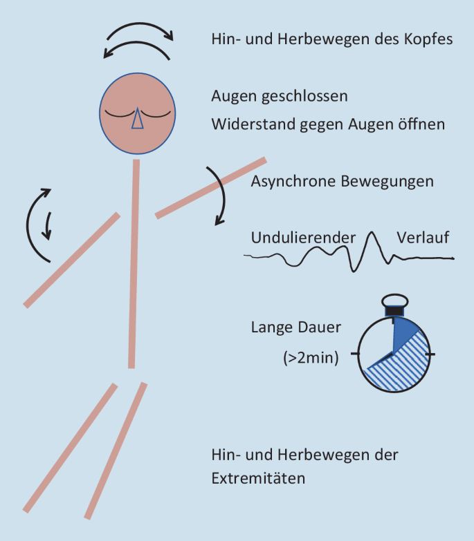 Dissoziative Anfälle frühzeitig erkennen | SpringerLink