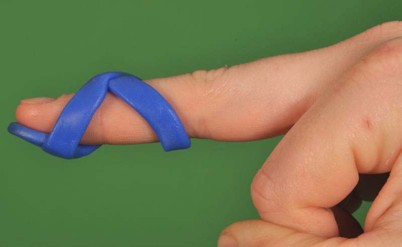 Der streckseitige Endgliedbasisbruch am Finger | SpringerLink