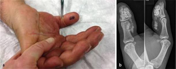 Management peripherer Verletzungen der Finger | SpringerLink
