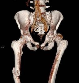 Schweres Stumpfes Thoraxtrauma Nach Skikollision Springerlink