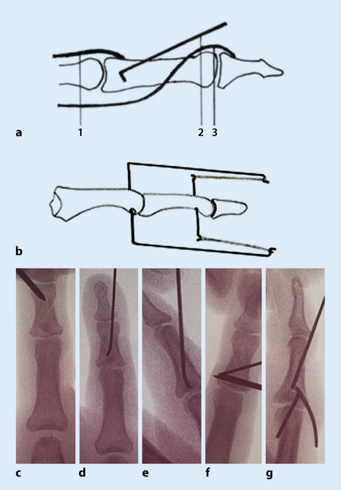 Mittelgliedbasisimpressionsfrakturen der Finger | SpringerLink