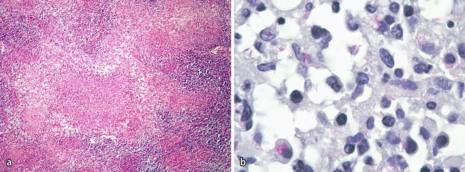 die behandlung der tuberkulosen meningitis bei erwachsenen