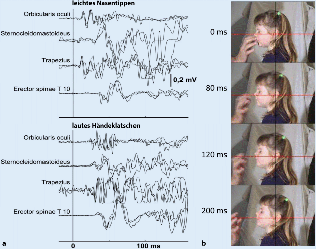 Was ist eine Myoklonie?