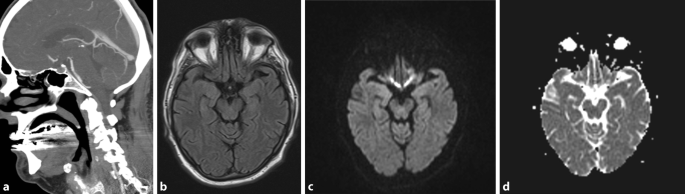 Stroke Mimics Kontrastmittelinduzierte Neurotoxizitat Als Seltene Ursache Springerlink