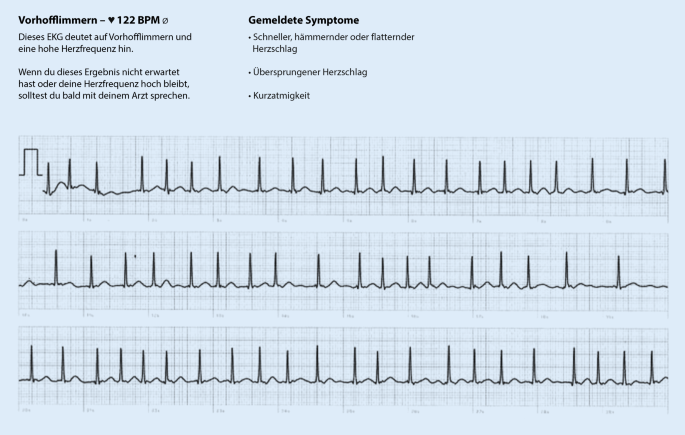 Vorhofflimmerndiagnostik mittels EKG-fähiger Smartwatches | SpringerLink