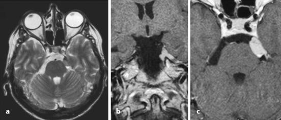 difenilbotriasis az mri- n)