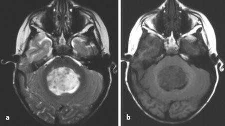 difenilbotriasis az mri- n