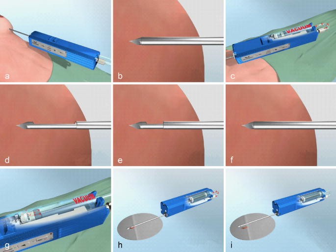 Sonographisch Gesteuerte Minimalinvasive Biopsie Unklarer Mammalasionen Springerlink