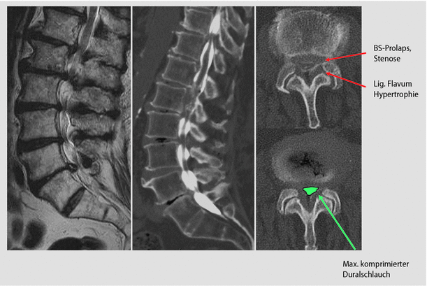 Der lws behandlung steilstellung Protrusion L4/L5