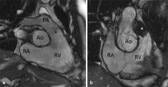 Untersuchungstechniken und Stellenwert der MRT bei der Diagnostik von  Herzklappenerkrankungen | Die Radiologie | Springer Nature Link