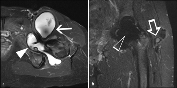CT und MRT der Hftprothese | Die Radiologie | Springer Nature Link