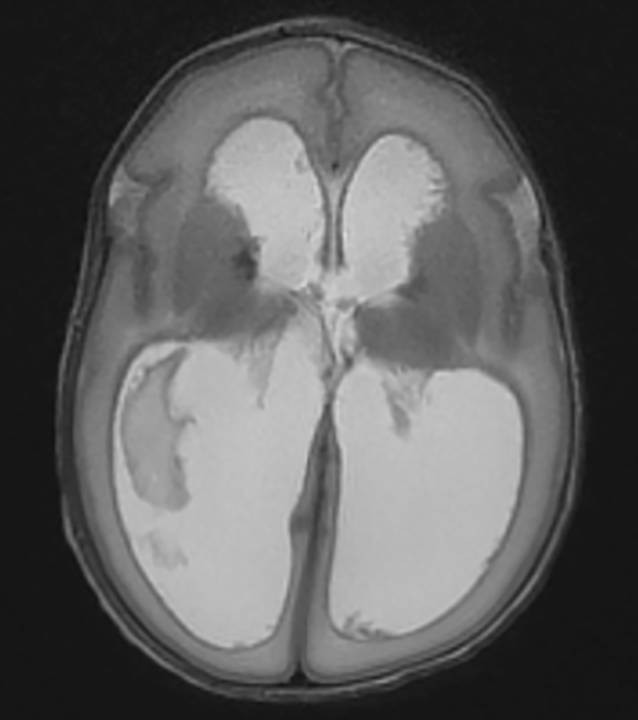 Magnetresonanztomographie des Gehirns bei Säuglingen und Kleinkindern |  SpringerLink