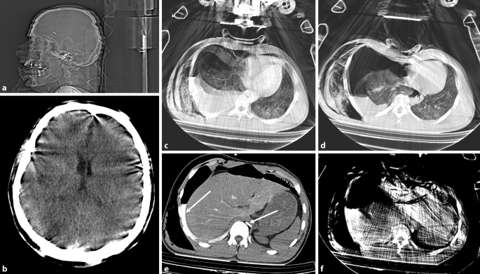 Update Polytrauma Und Computertomographie Unter Reanimationsbedingungen Springerlink