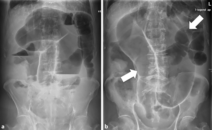 Akutes Abdomen Ein Praktischer Zugang Springerlink
