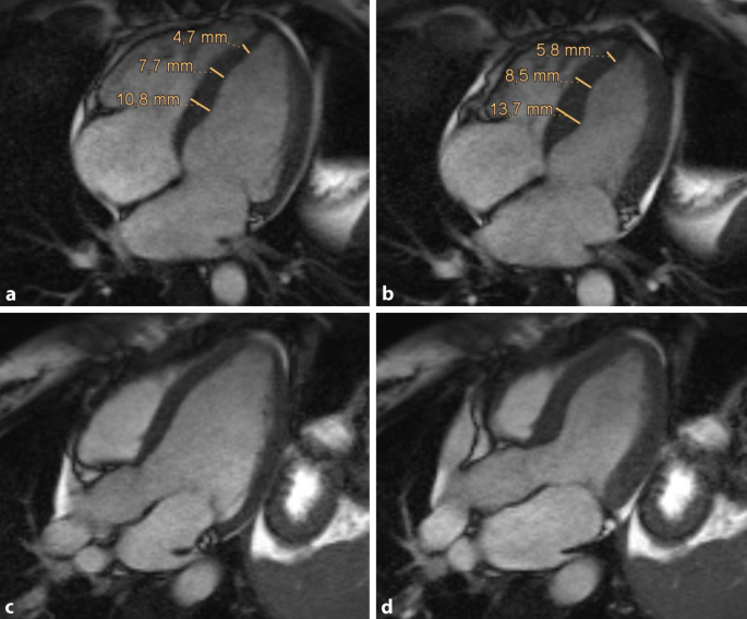Akute Herzinsuffizienz Einer Freizeitsportlerin Springerlink