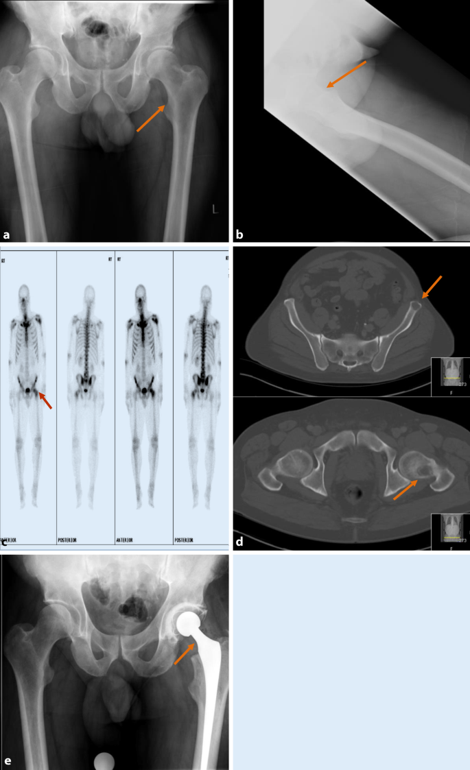 Bone Metastases Images and Xrays