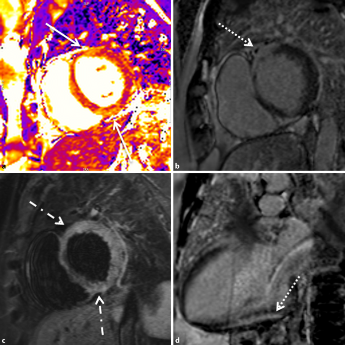 Slagskib Allerede vand Cardiac MRI—Update 2020 | SpringerLink