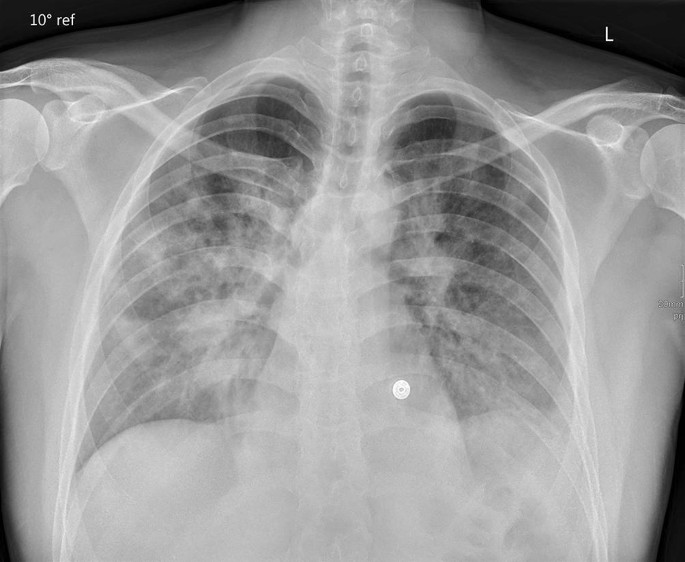 Radiologische Manifestationen von Lungenerkrankungen bei COVID-19 |  SpringerLink