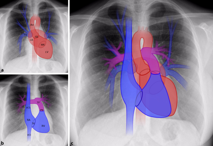 Herz Und Lunge Im Rontgenbild Springerlink