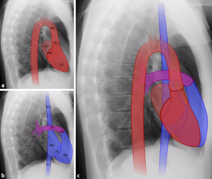 Herz Und Lunge Im Rontgenbild Springerlink