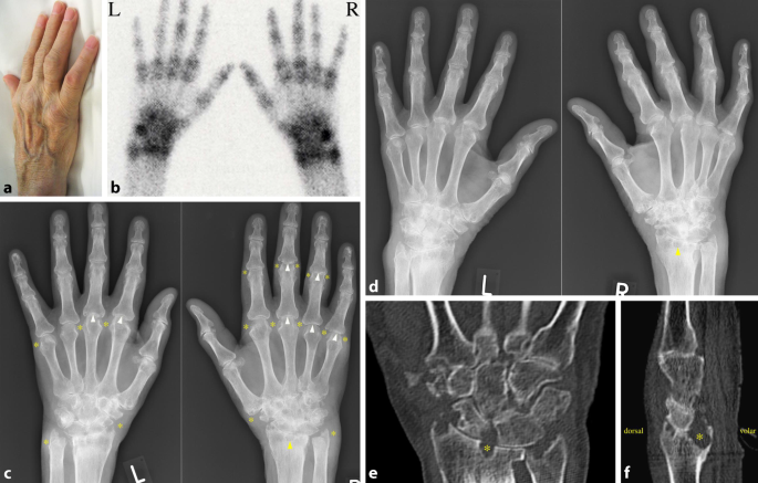 Rheumatoide Arthritis der Hand | SpringerLink