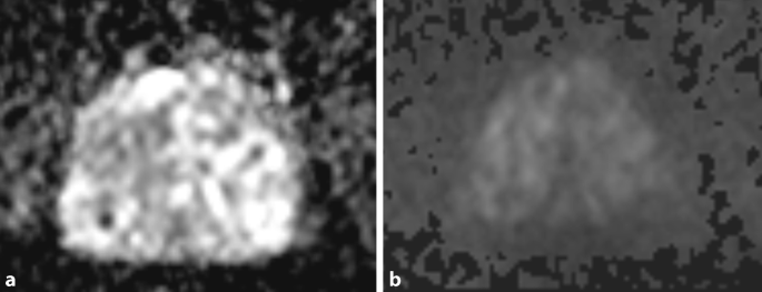 PI-RADS 2.1 und strukturierte Befundung der Magnetresonanztomographie der  Prostata | SpringerLink