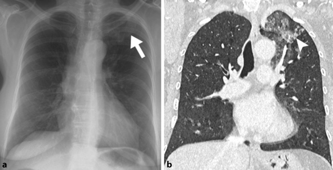 Röntgenbefunde bei diffusen parenchymatösen Lungenerkrankungen |  SpringerLink