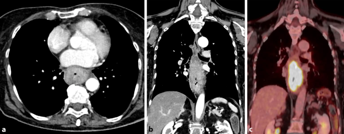 Einfluss des Rauchens auf den Gastrointestinaltrakt | Die Radiologie |  Springer Nature Link