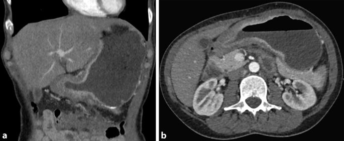 Einfluss des Rauchens auf den Gastrointestinaltrakt | Die Radiologie