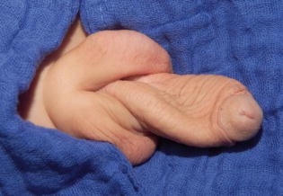 Penis- und Harnröhrenmissbildungen | SpringerLink