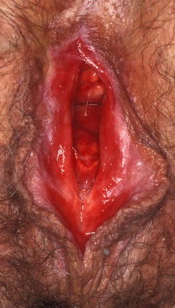 Klitoris juckt