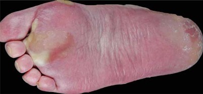 Hypertonie und Hand-Fuß-Syndrom | Die Urologie